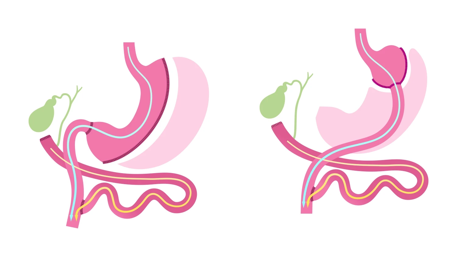 Wie funktioniert die Biliopankreatische Diversion?