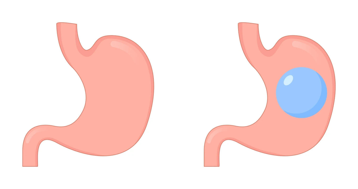 Wie funktioniert der Magenballon?