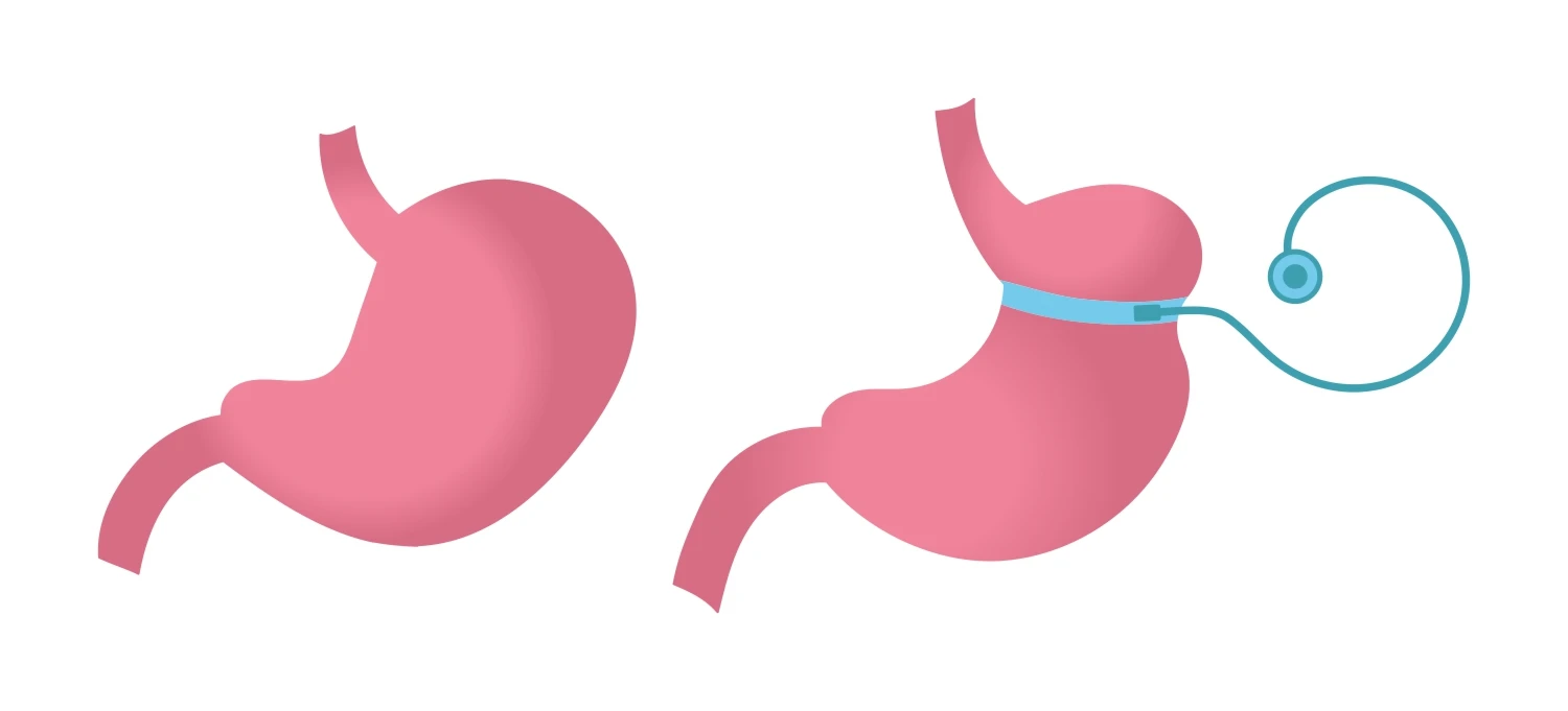 Wie funktioniert das Magenband?