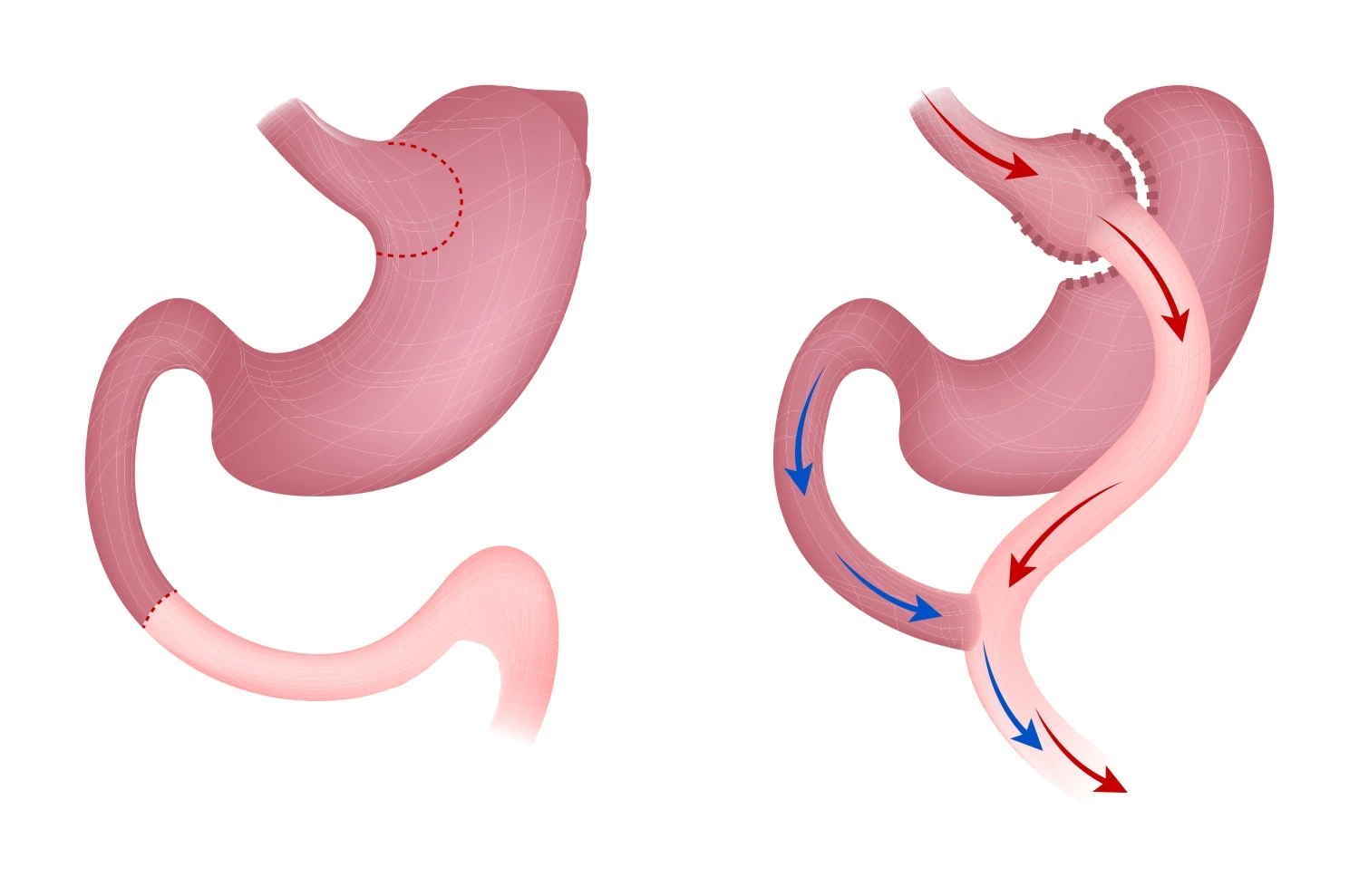 Wie funktioniert der Magenbypass?