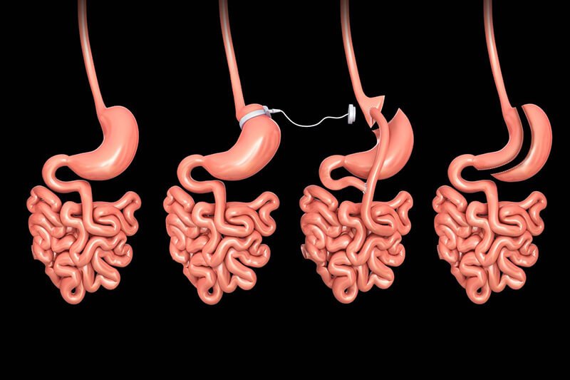 Methoden der Magenverkleinerung