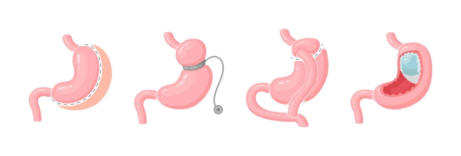 Methoden der Magenverkleinerung