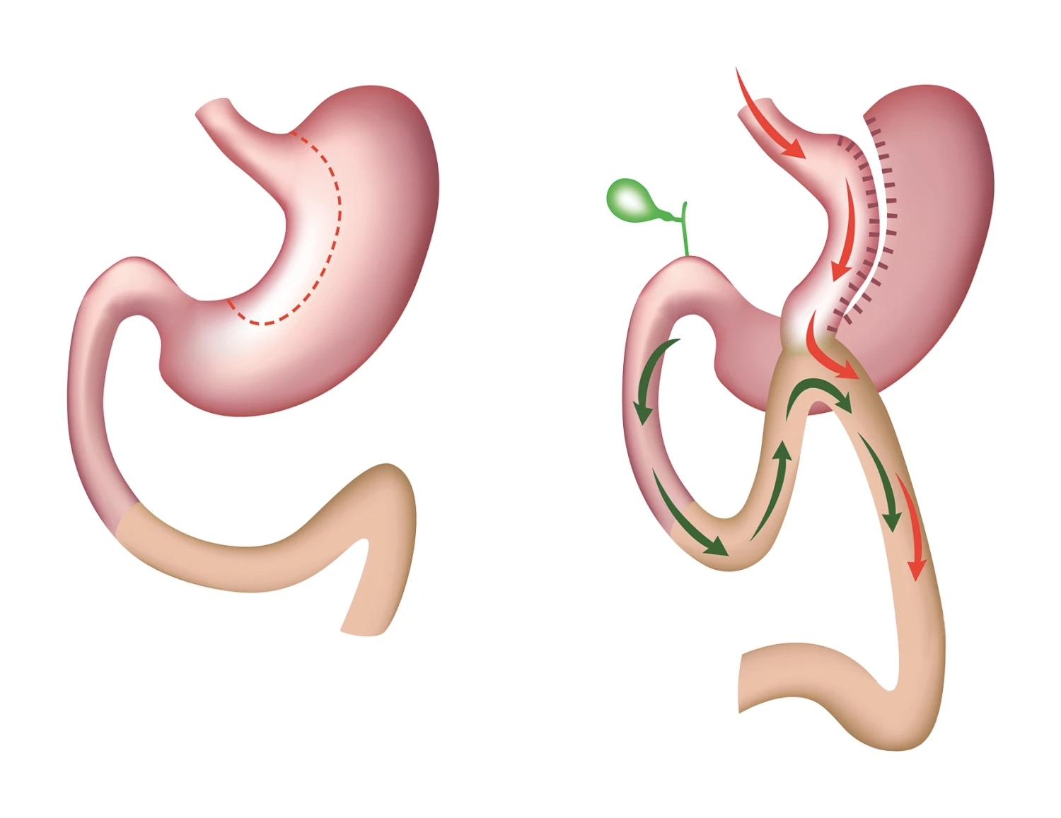 Wie funktioniert der Mini-Magenbypass?