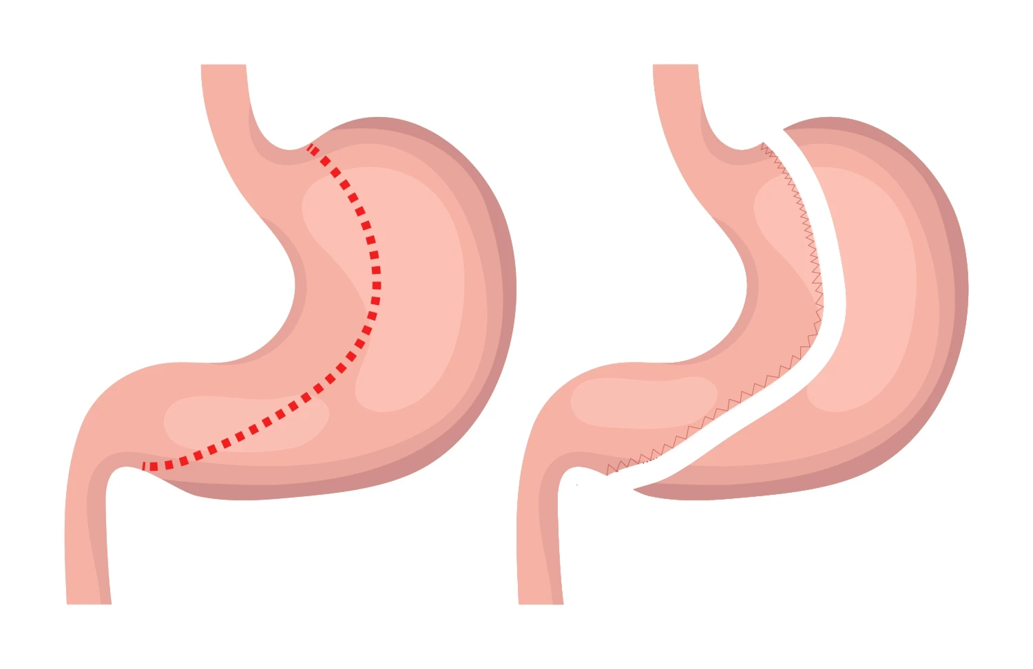 Wie funktioniert der Schlauchmagen?
